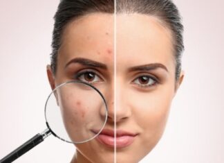 25 Tips on How to Get Rid of Acne Fast and Naturally How