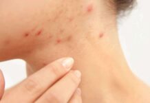 Acne on Neck: Causes, Remedies, and Prevention Acne on Neck